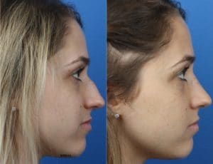 female rhinopalsaty patient's before and after photos in new york