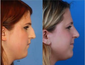 A female undergoes rhinoplasty surgery with Dr. Philip Miller and shows her before and after results.