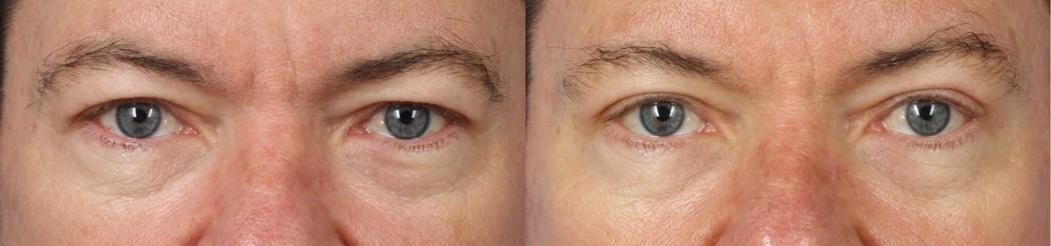 blepharoplasty before and after in new york