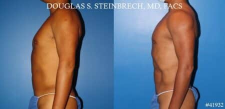 Body banking with fat transfer to the pecs and shoulders by Dr. Steinbrech