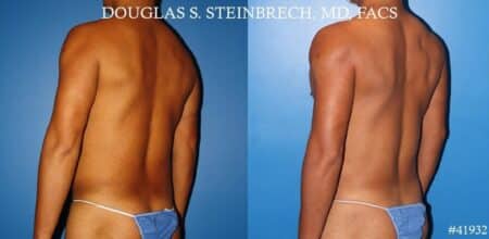 Body banking with fat transfer to the pecs and shoulders by Dr. Steinbrech