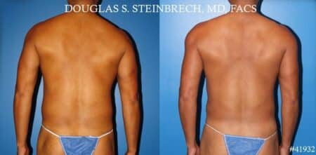 Body banking with fat transfer to the pecs and shoulders by Dr. Steinbrech