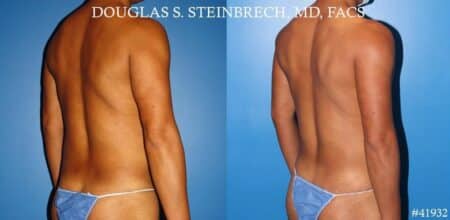 Body banking with fat transfer to the pecs and shoulders by Dr. Steinbrech