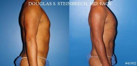 Body banking with fat transfer to the pecs and shoulders by Dr. Steinbrech