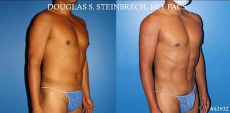 Body banking with fat transfer to the pecs and shoulders by Dr. Steinbrech