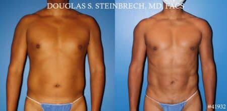 Body banking with fat transfer to the pecs and shoulders by Dr. Steinbrech