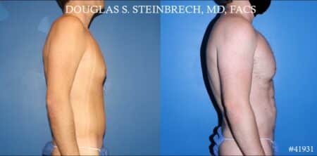 Body banking with fat transfer by Dr. Steinbrech