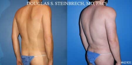 Body banking with fat transfer by Dr. Steinbrech