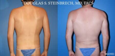 Body banking with fat transfer by Dr. Steinbrech