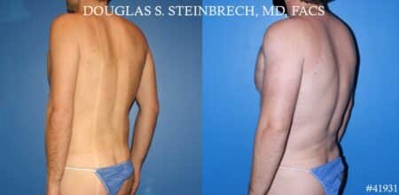 Body banking with fat transfer by Dr. Steinbrech