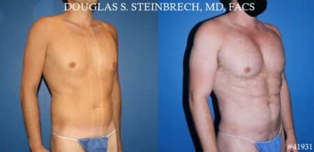 Body banking with fat transfer by Dr. Steinbrech