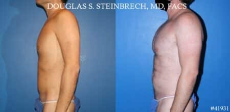 Body banking with fat transfer by Dr. Steinbrech