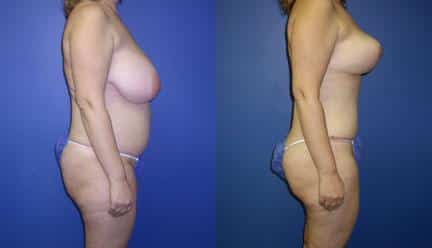 Body Contouring Procedures in NYC - LUXURGERY Aesthetic Surgery