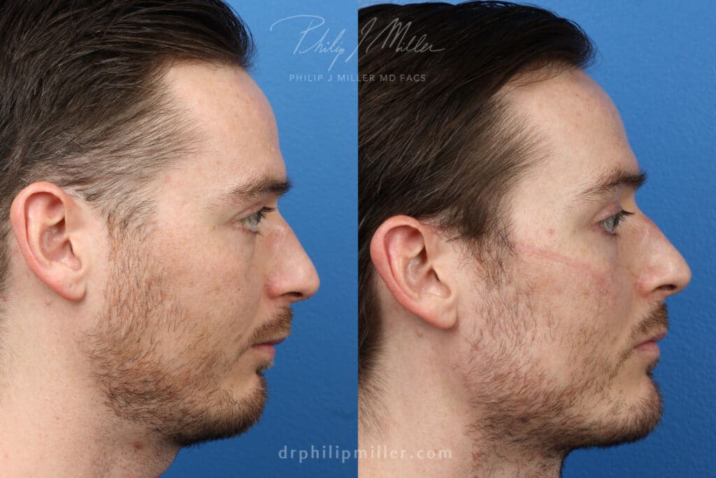 Chin implant to strengthen chin by Dr. Miller. After surgery, chin is stronger and proportionate to other facial features.