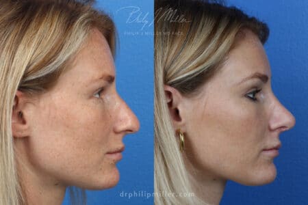 Rhinoplasty to correct the nasal bridge and tip by Dr. Miller