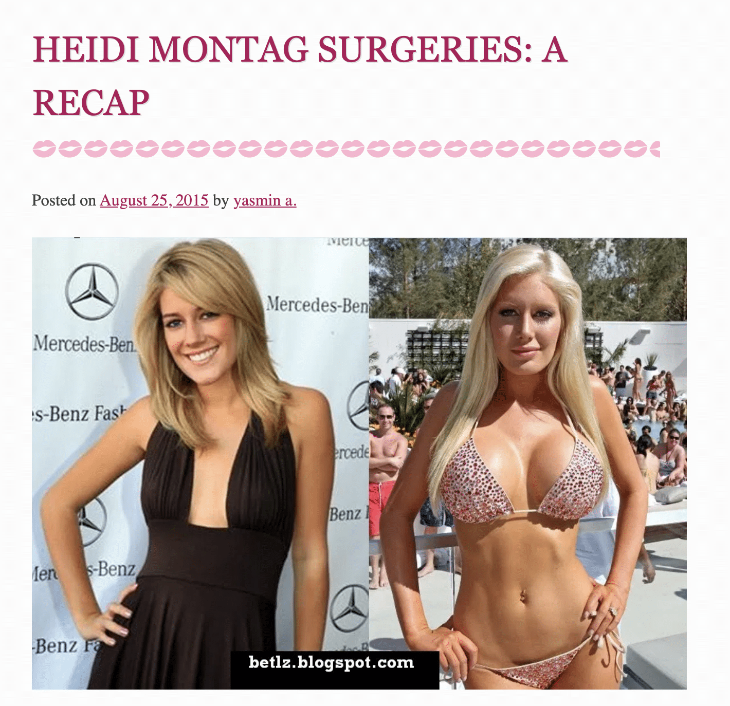 Heidi Montag Surgeries: A Recap