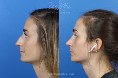 Rhinoplasty Left to correct nasal bridge female Miller