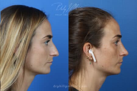 Rhinoplasty-right-to-correct-nasal-bridge-female-Miller