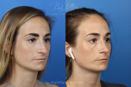 Rhinoplasty-to-correct-nasal-bridge-female-Miller