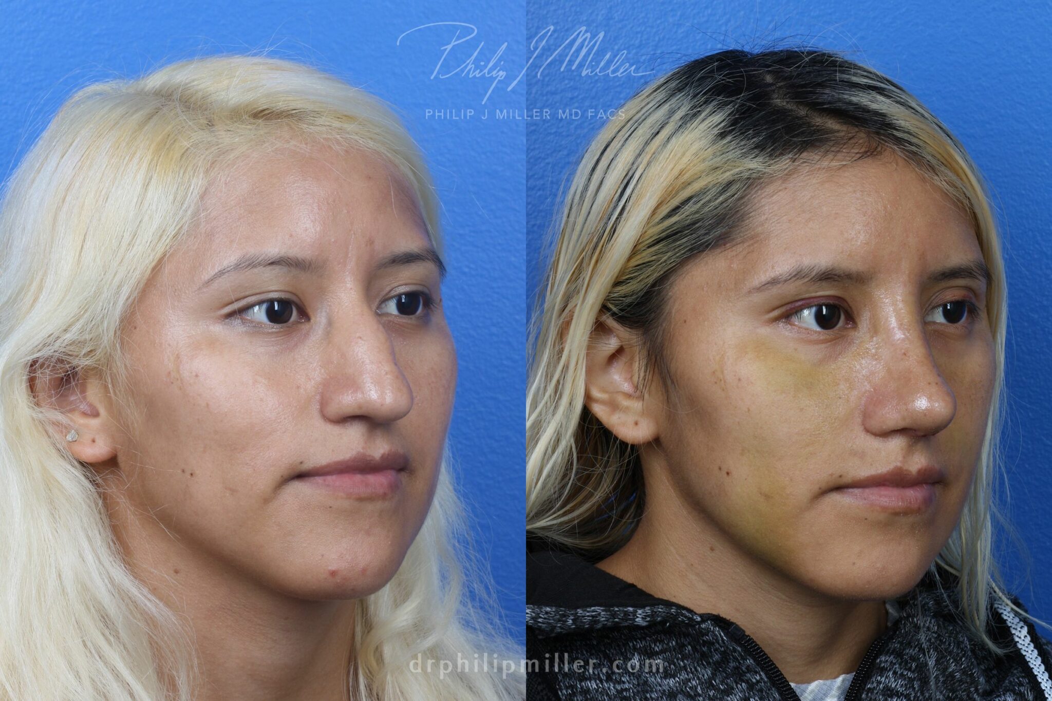 Rhinoplasty to remove hump from nasal bridge and refine the tip by Dr. Miller. After surgery, dorsal hump is removed and tip is slightly rotated and refined.