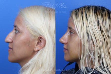 Rhinoplasty to remove hump from nasal bridge by Dr. Miller