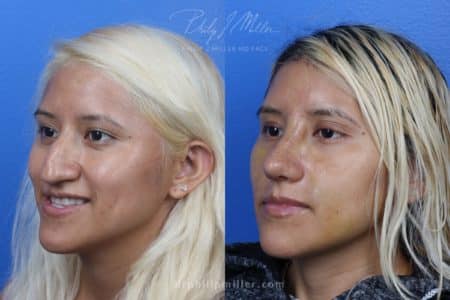 Rhinoplasty to remove hump from nasal bridge by Dr. Miller