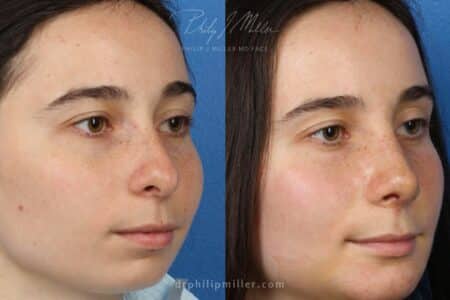 Rhinoplasty to straighten bridge and refine tip by Dr. Miller