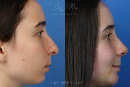 Rhinoplasty to straighten bridge and refine tip by Dr. Miller