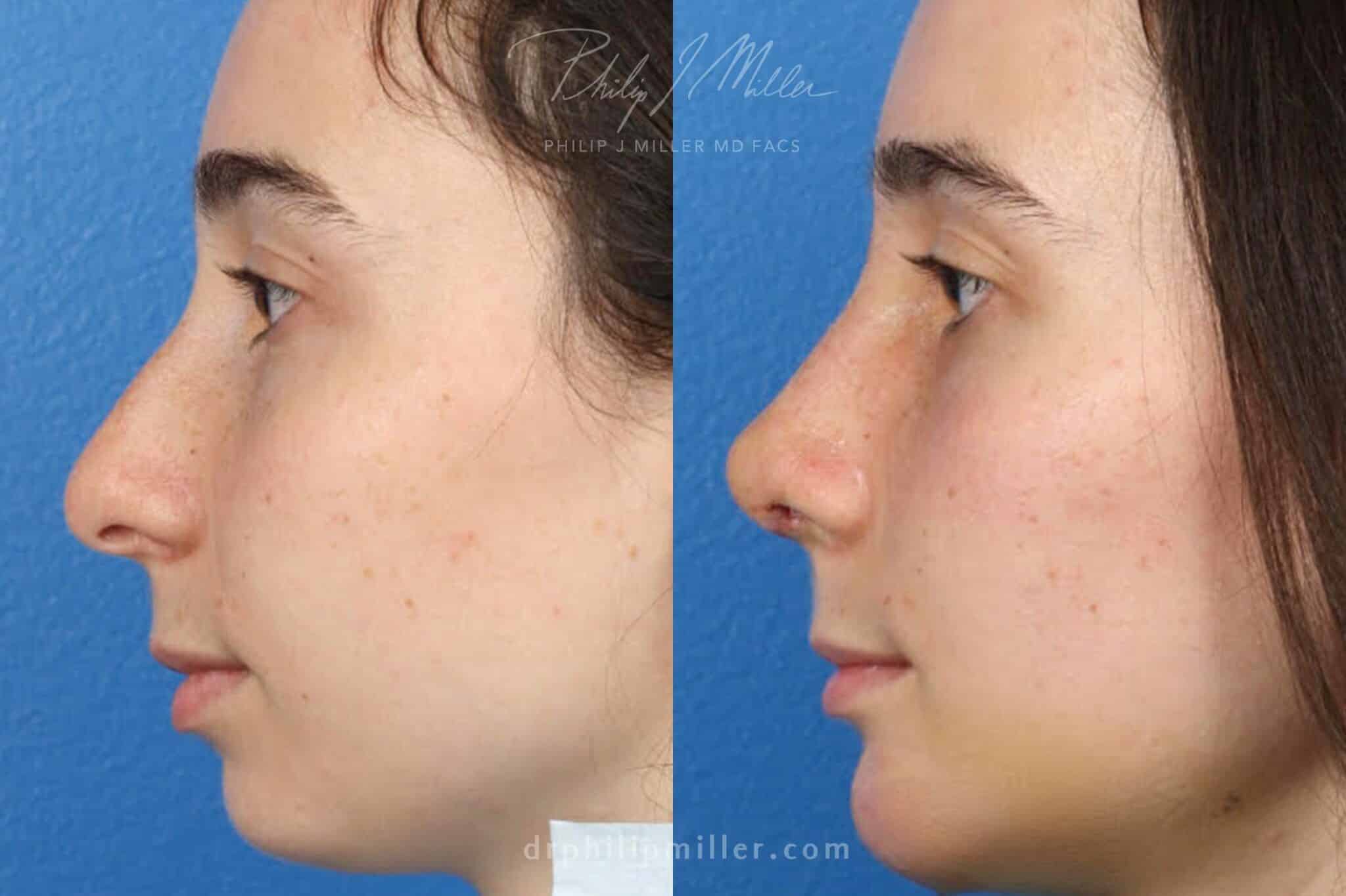 Rhinoplasty to correct nasal bridge and tip by Dr. Miller. After surgery, bridge is straighter and tip is slightly rotated and refined.