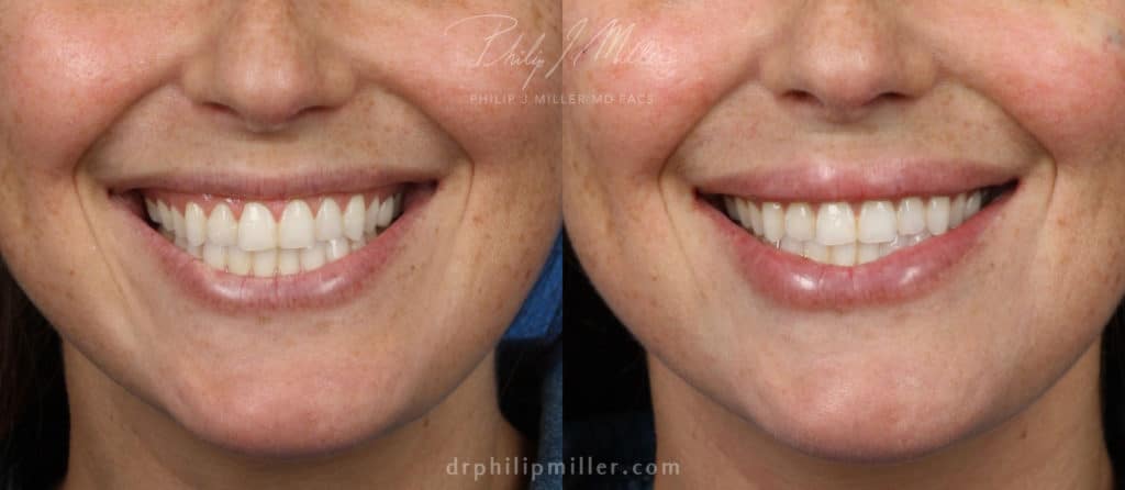 Lip filler to plump up the lips by Dr. Miller. After treatment, lips are fuller and shapelier without looking unnatural.