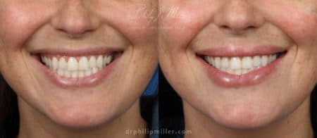 Lip filler to plump up the lips by Dr. Miller