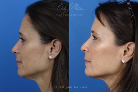 Miller Lift to treat facial wrinkles