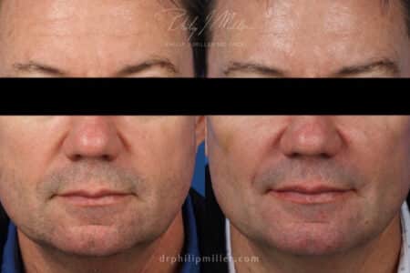 Miller Lift to treat facial wrinkles and sculpt jawline by Dr. Miller