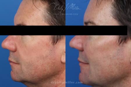 Miller Lift to treat facial wrinkles and sculpt jawline by Dr. Miller