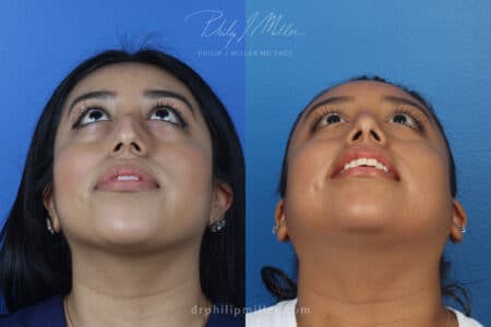 Rhinoplasty to remove bump from dorsal bridge by Dr. Miller