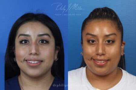 Rhinoplasty to remove bump from dorsal bridge by Dr. Miller