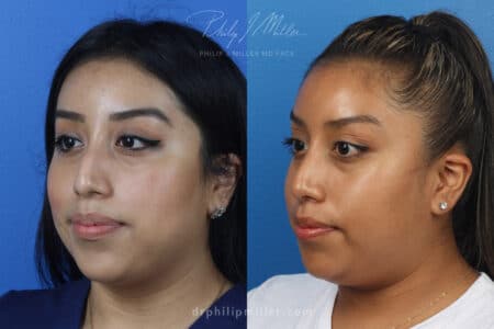 Rhinoplasty to remove bump from dorsal bridge by Dr. Miller