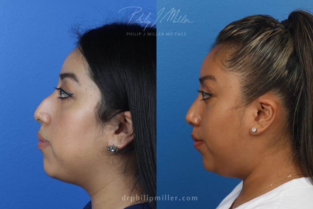 Rhinoplasty to remove dorsal hump from nasal bridge by Dr. Miller. After surgery, bridge is straighter for a more aesthetically pleasing profile.