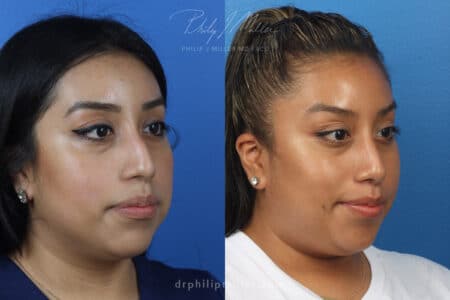 Rhinoplasty to remove bump from dorsal bridge by Dr. Miller