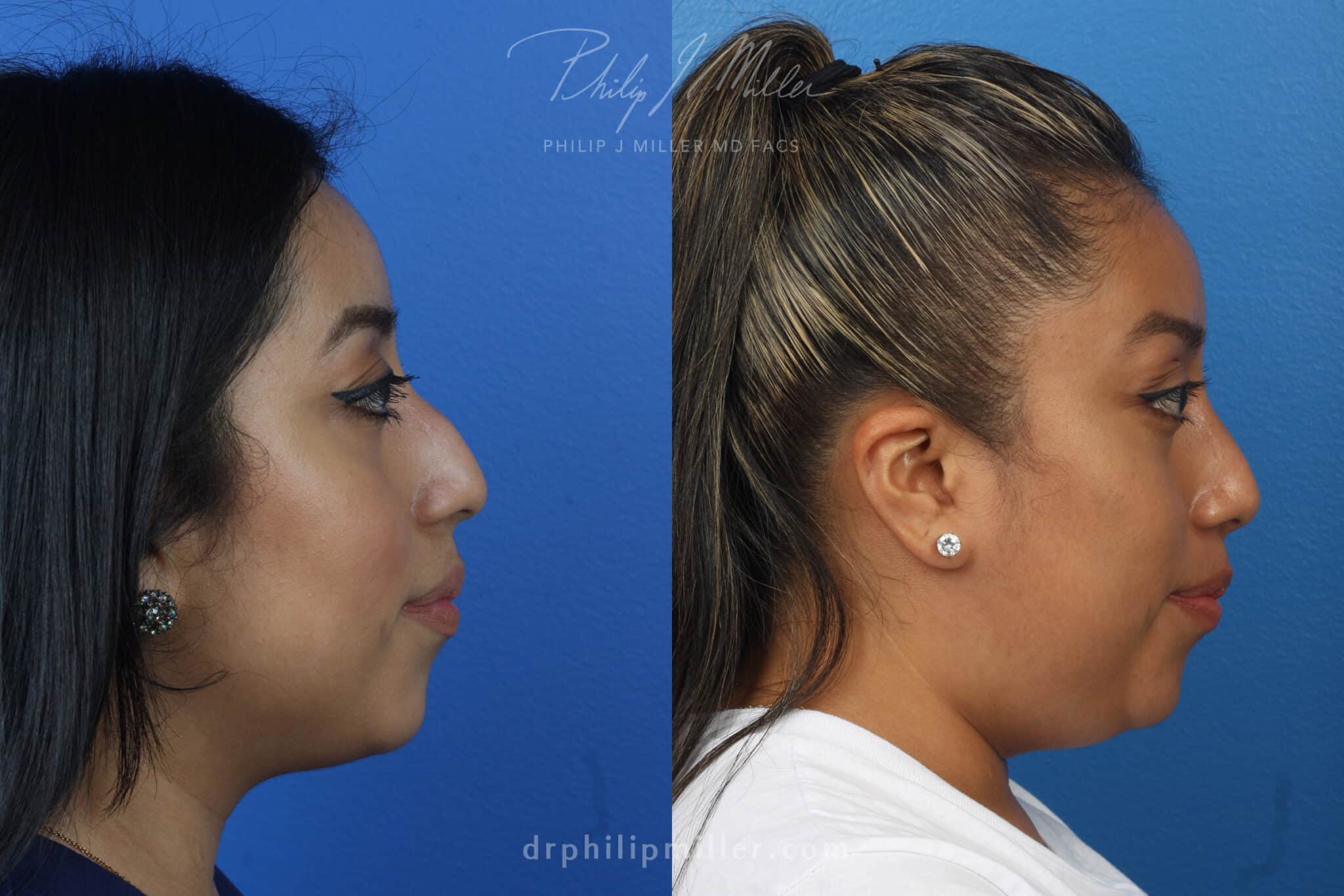 Rhinoplasty to remove dorsal hump from nasal bridge by Dr. Miller. After surgery, bridge is straighter for a more aesthetically pleasing profile.