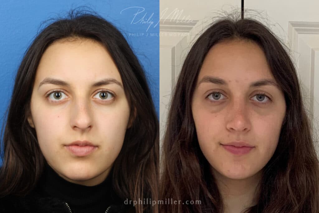 Rhinoplasty to straighten bridge and refine the nasal tip of a female patient by Dr. Miller. Surgery removes dorsal hump from bridge and refines the nasal tip to improve the patient's facial profile.