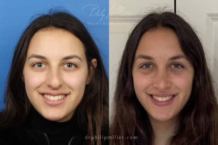 Rhinoplasty to straighten bridge and refine nasal tip by Dr. Miller