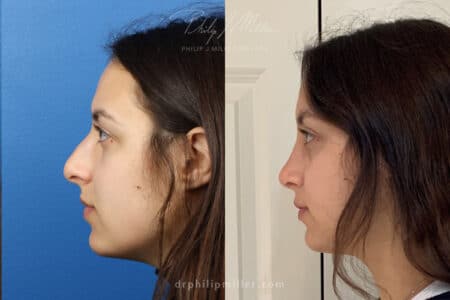 Rhinoplasty to straighten bridge and refine nasal tip by Dr. Miller