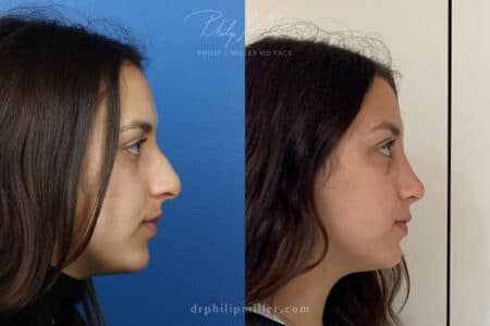 Rhinoplasty to straighten bridge and refine nasal tip by Dr. Miller