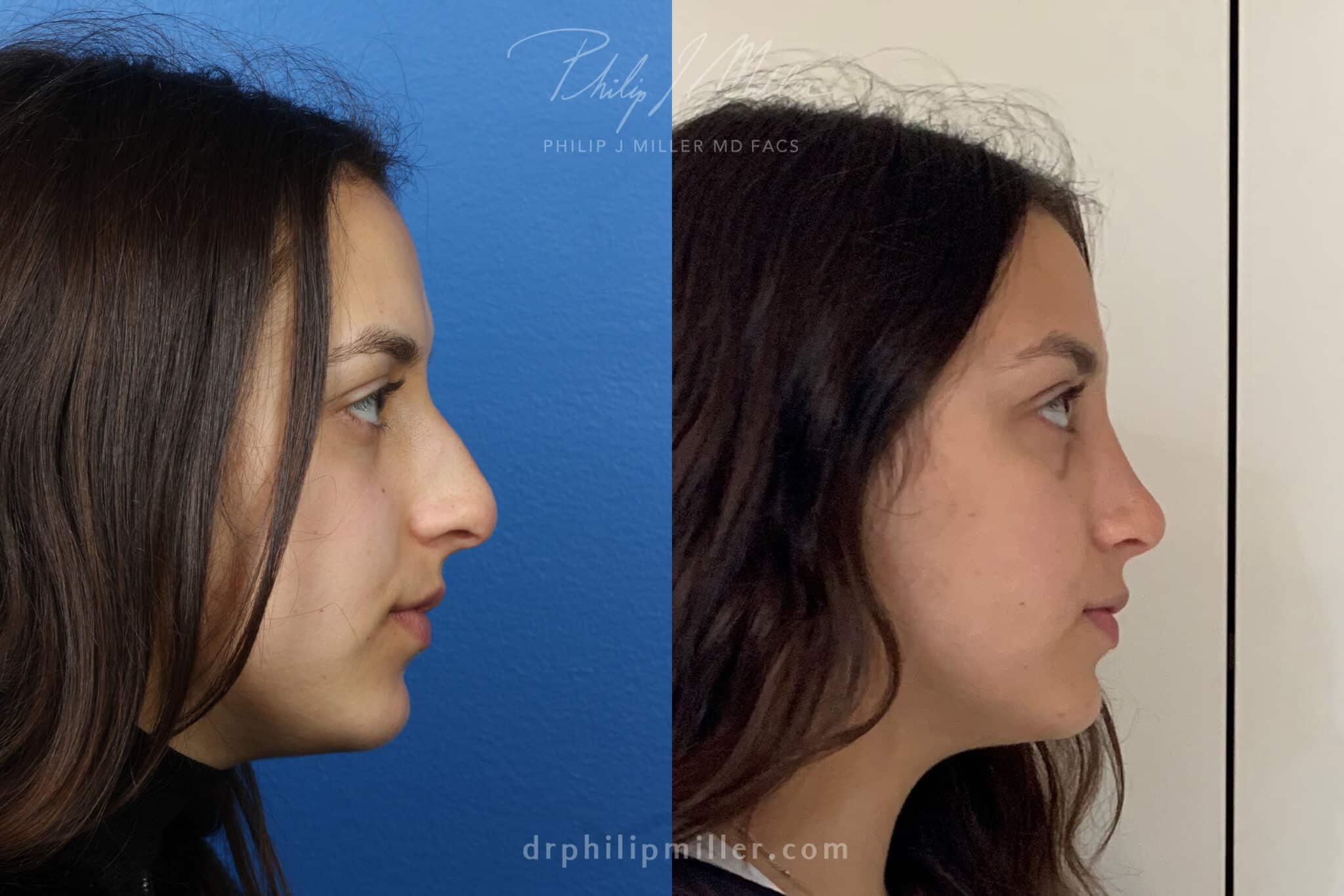 Rhinoplasty to straighten bridge and refine the nasal tip of a female patient by Dr. Miller. Surgery removes dorsal hump from bridge and refines the nasal tip to improve the patient's facial profile.