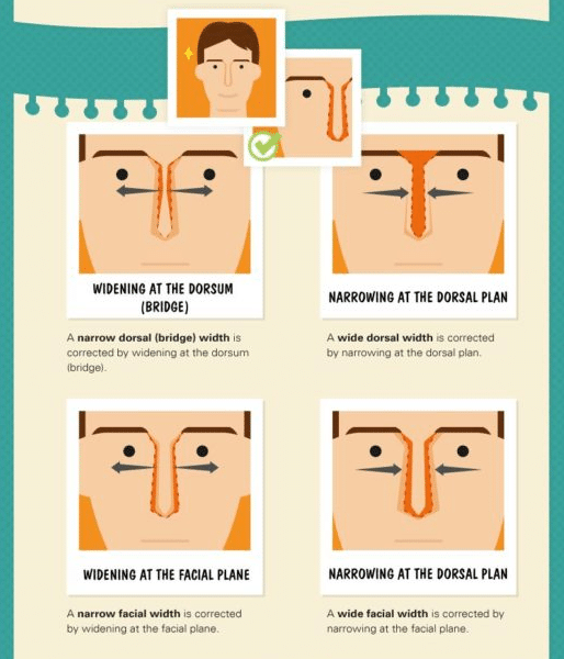 nose job treatment diagram by Dr. Philip Miller in New York