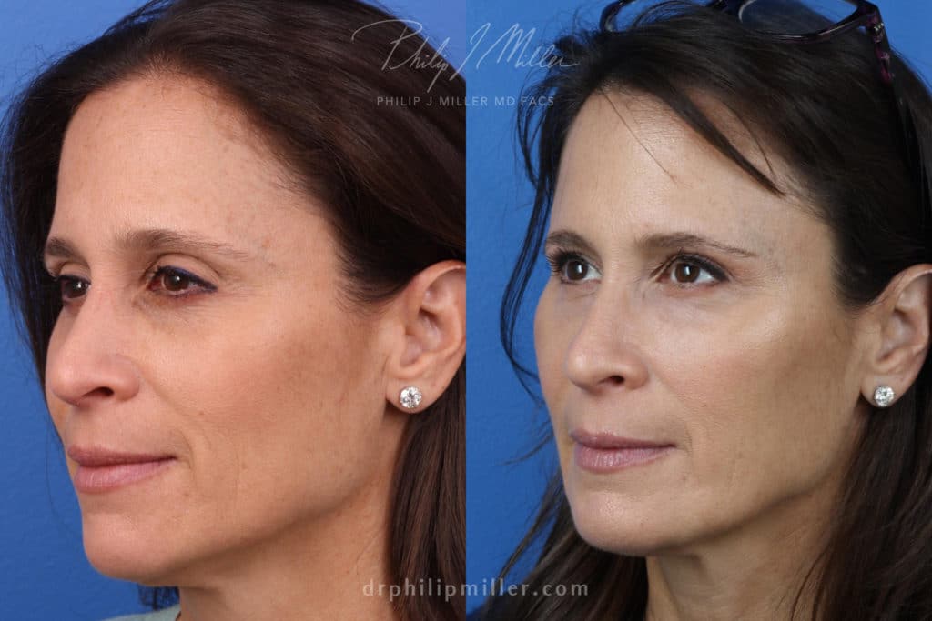 restylane filler for non-surgical facelift in new york