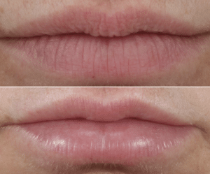 restylane lip filler in new york, ny