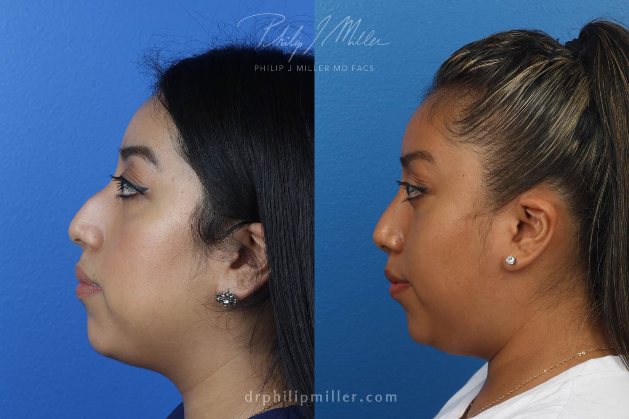 female rhinoplasty patient in new york