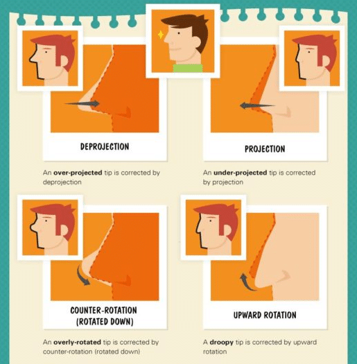 Rhinoplasty nose terms infographic by Dr. Philip Miller in New York